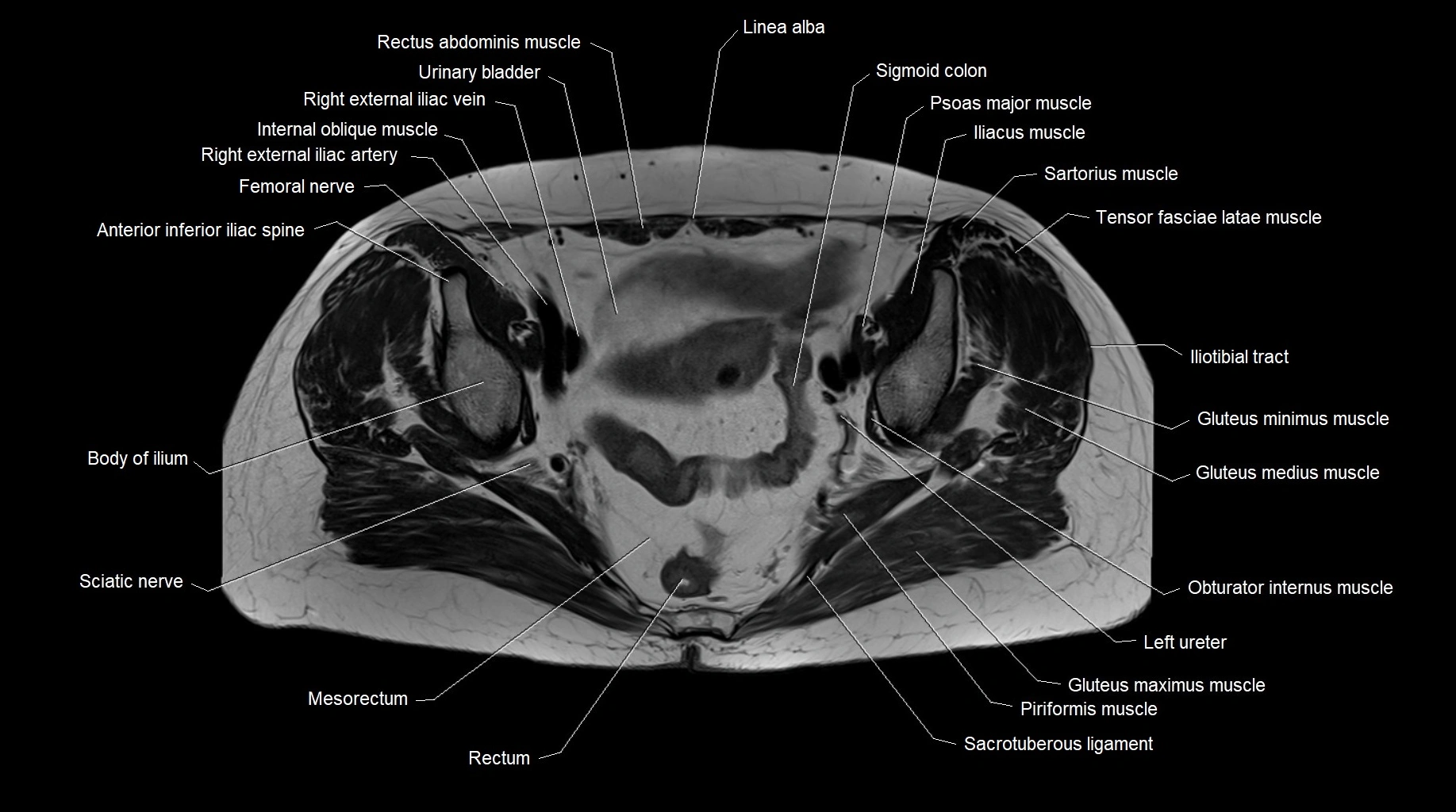 MRI 3T pelvis axial cross section anatomy image 17.webp